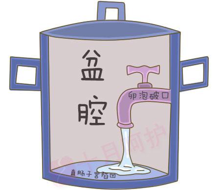 子宫直肠窝少量积液，解读与应对